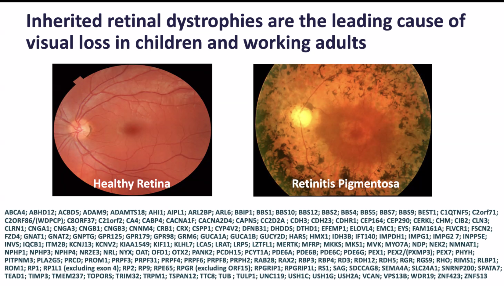 Image of healthy retina and one with retinitis pigmentosa